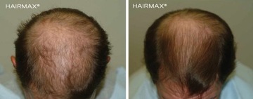 Для тонких волос, для слабых волос -Hairmax Ultima 12.