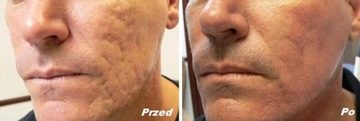 Revitol Scar Cream от шрамов, шрамов от прыщей.